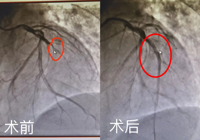 【生死时速 为生命护航】心梗患者感激送锦旗