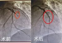0401【生死时刻，全力以赴】武宁县人民医院成功抢救一名急性心肌梗死患者
