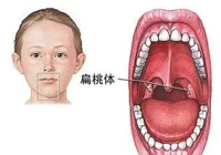 【健康科普】儿童扁桃体、腺样体肿大，要手术吗？