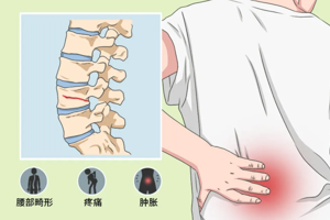 【健康科普】一声咳嗽就骨折？老人腰痛别硬扛！警惕骨质疏松性腰椎骨折