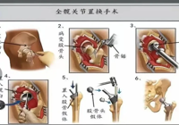 【告别跛行疼痛 重塑灵动髋关节】髋关节置换术，重启无痛自在生活