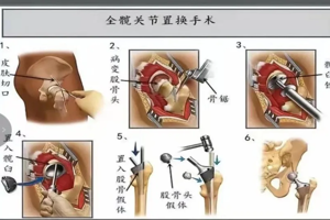 【告别跛行疼痛 重塑灵动髋关节】髋关节置换术，重启无痛自在生活